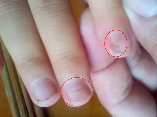 小孩指(趾)甲变形,双层中间空,如图,是什么引起的,怎样治疗,以后有