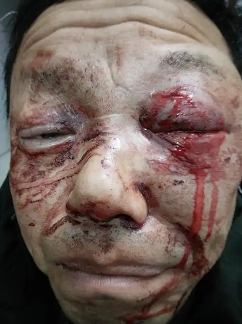 左眼眼球破裂术前手术一百天后的照片(左眼为义眼.