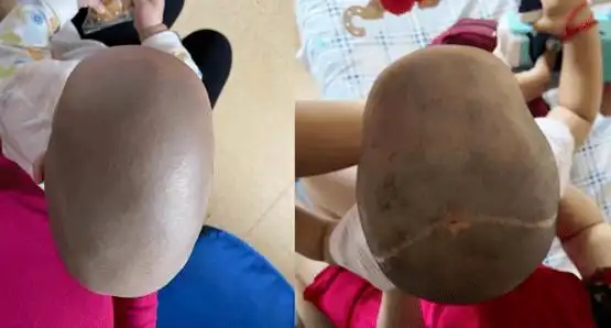 图4病例2患儿7个月发现舟状头畸形确诊为矢状缝早闭.