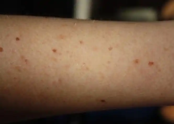 皮肤癌早期症状图片
