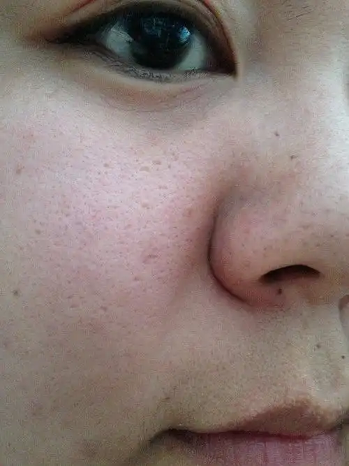 外油内干粗大毛孔黑色素聚集怎么破怎么破嘛有图有真相