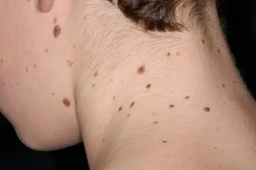 容易癌变的黑痣图片 (59)