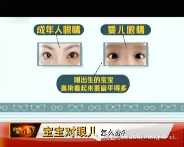 宝宝斗鸡眼也有真性假性别忙着担心一招教您学会区分