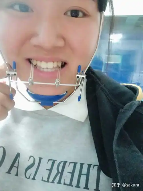 有没有治疗反颌地包天戴过矫治器面框的人呀