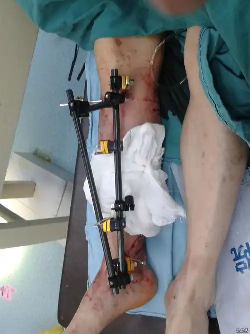 胫骨外固定支架请大家指正