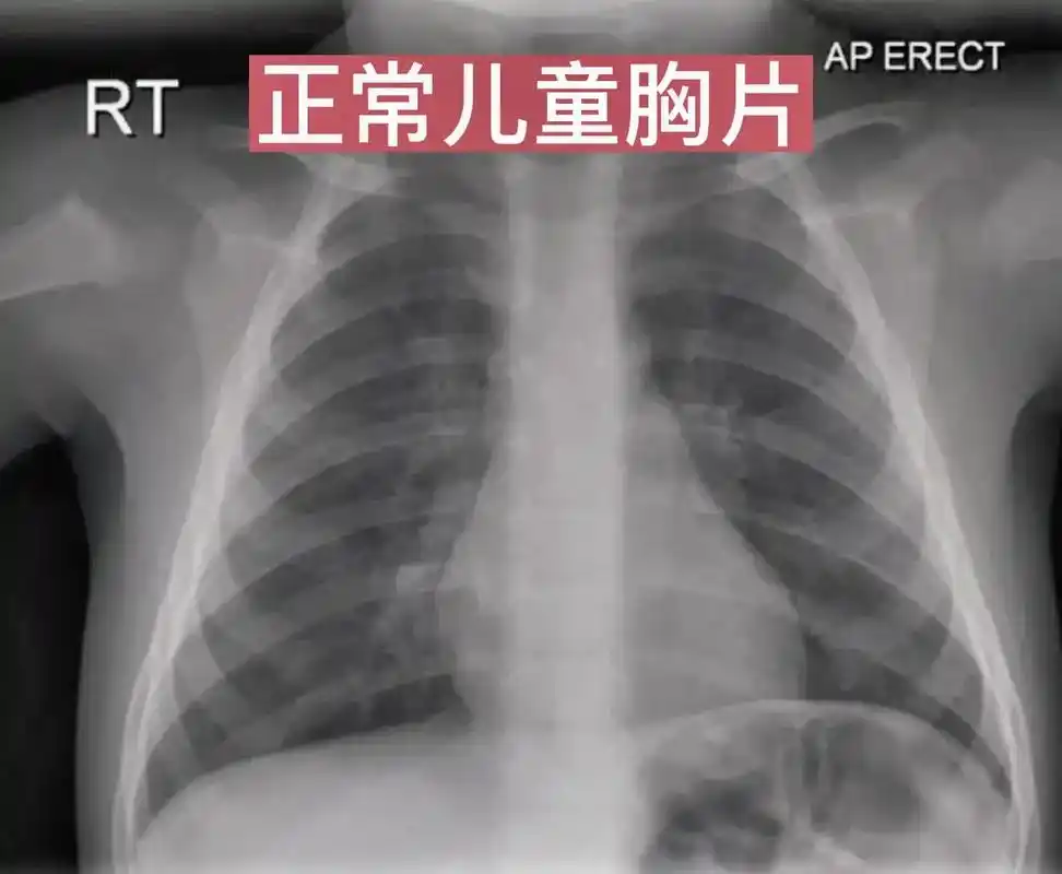 一分钟教你看胸片,识别各种肺炎.