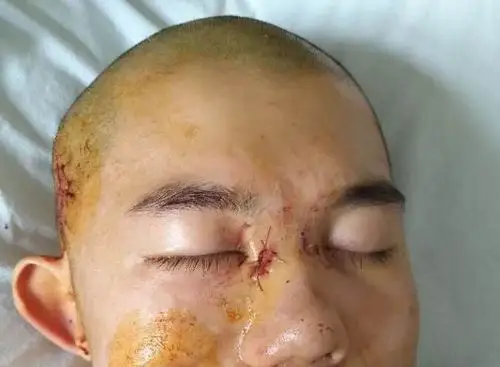 张力性悬吊治疗晚期面瘫病例一例