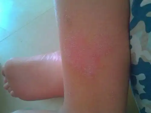 皮癣早期症状图片 (15)_有来医生