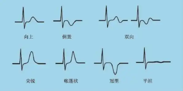 心电图波形与正常值