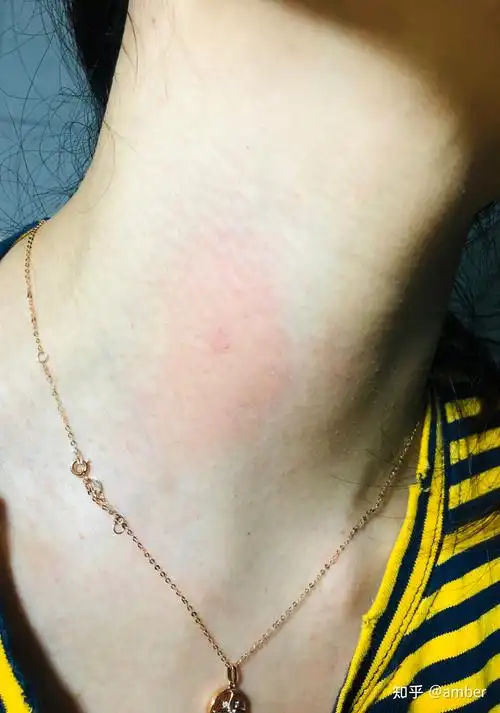 如何快速消除吻痕,亲测有效!