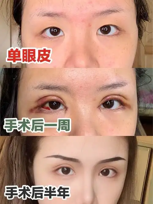 全切双眼皮77开眼角77肿眼泡矫正78手术过程&术后护理_圈子