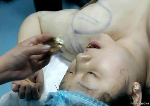 女网红吸脂致死,为什么吸脂手术,没有你想象的那样美好?