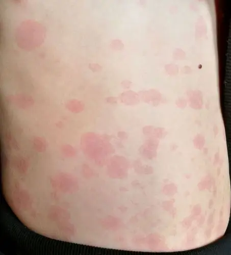 传染性红斑-朱敏刚主任医师-爱问医生