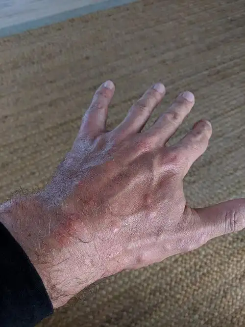 英汉疑被床虱叮咬150次