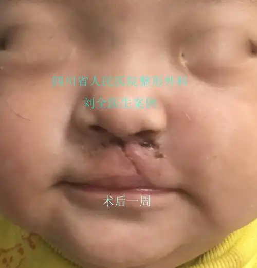 唇裂及鼻畸形修复