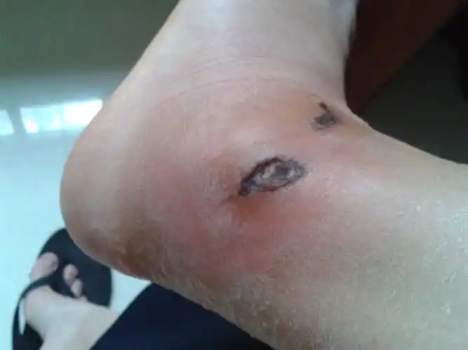 前段时间被撞脚踝受伤了然后脚踝那片区域肿起来然后脚后跟