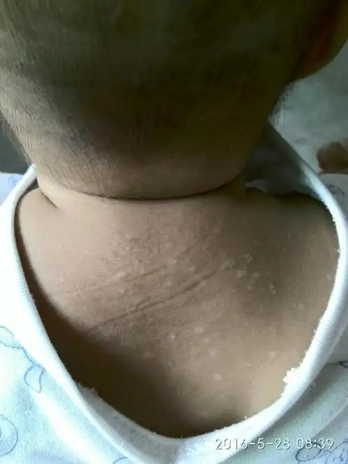 您好,我家宝宝三个月零几天,眉毛间长一点点白色的,背部也有,是汗斑吗