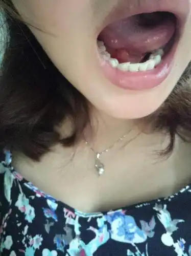 我舌头下面长了一个大肉泡,都很久,不动它就不会长,这是什么,求解?