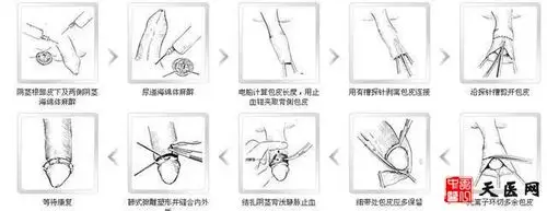 治疗包皮过长及包茎应该做什么手术