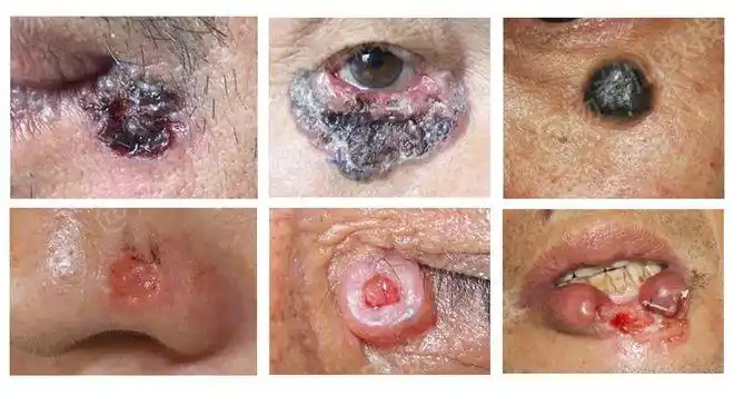 杨教授每周病例分享基底细胞癌