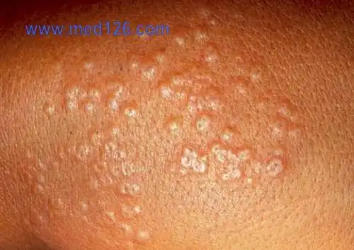 环状肉芽肿(granuloma annulare)05