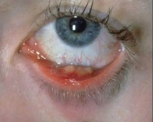 针眼是什么,怎么处理?