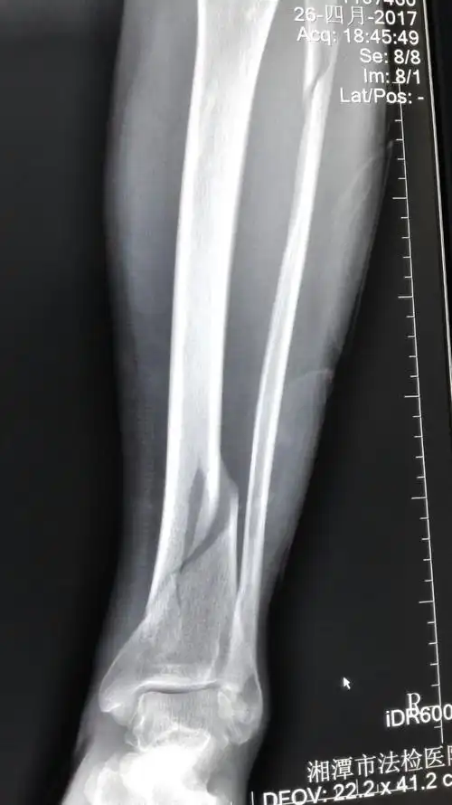 胫骨下段腓骨上段螺旋形骨折的治疗方案