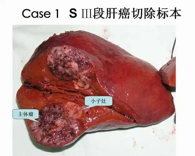 治愈性肝癌切除的最佳术式(附手术经过图片) - 好大夫在线
