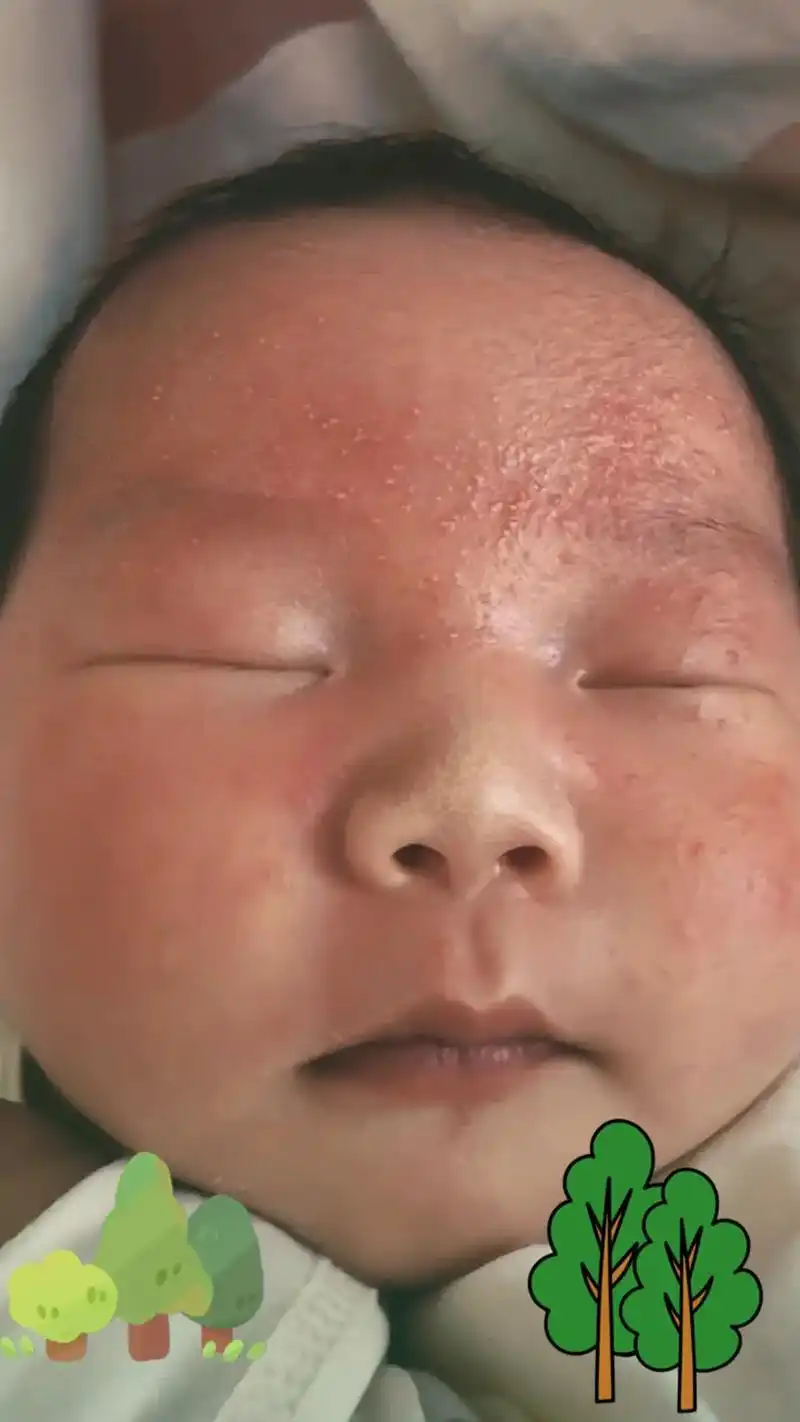 湿疹.宝宝得湿疹的宝妈看看,我们家宝宝之前脸上有小红点,还以 - 抖音