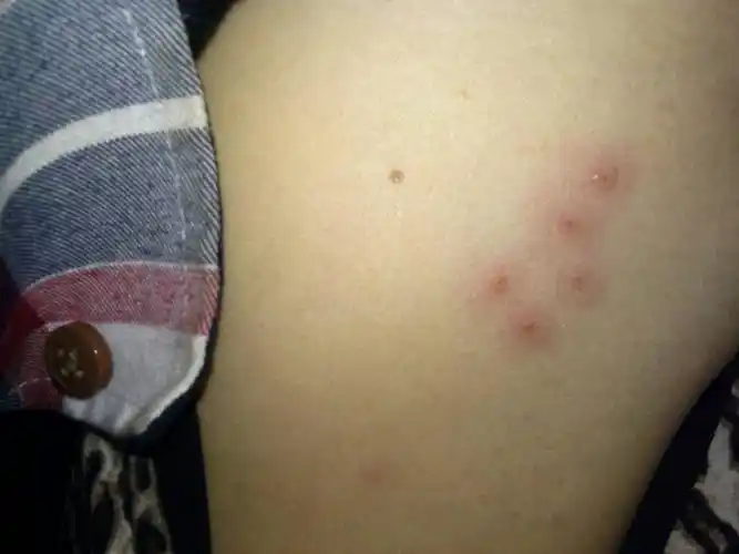 腋窝偏下长了5个疙瘩.