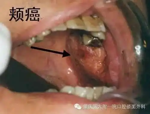 口腔颌面部常见肿瘤图谱