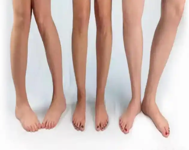 八字的对比研究(内八字,外八字孩子脚型正常不正常,家长可以这么判断)