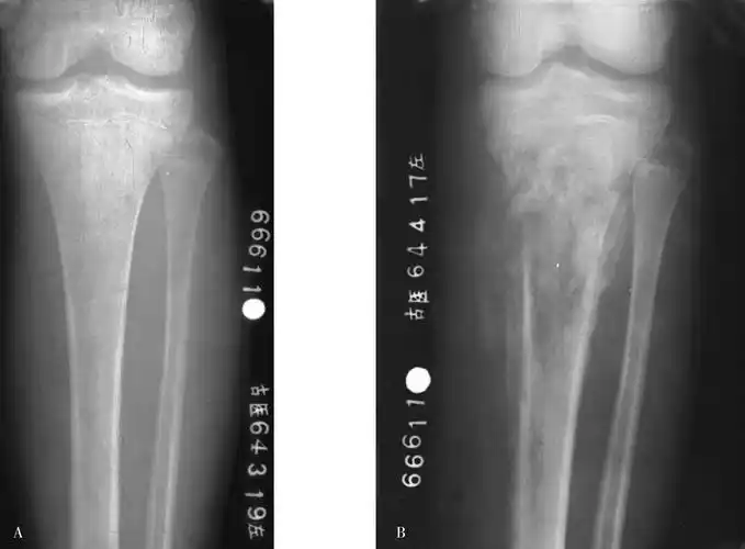 病例51 急性化脓性骨髓炎