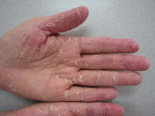 门诊病人 - 皮肤及性传播疾病讨论版 - 爱爱医医学论坛