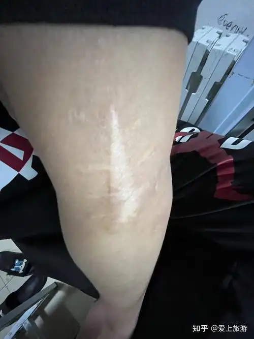 胳膊上有这样的伤疤还能去当兵吗大神求解