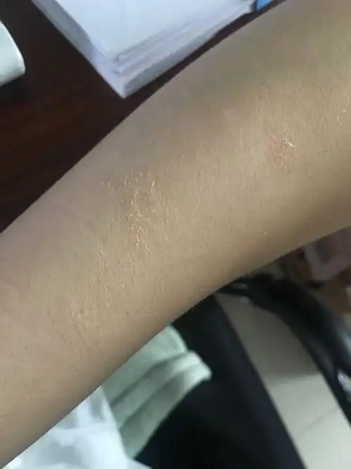 胳膊上起的癣 抹了药开始蜕皮 这是什么毛病 有好几块 开始会痒