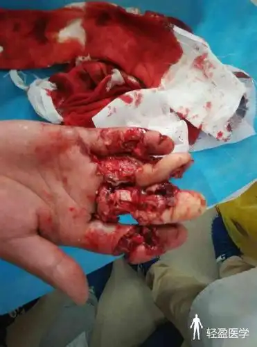 女,36岁,不慎被压面机碾伤右手致疼痛出血5小时