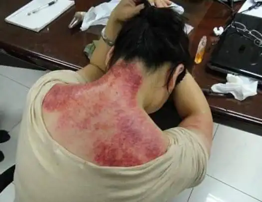 刮痧后后背出现一片红,是体内排出来的毒素吗?听医生来科普一下