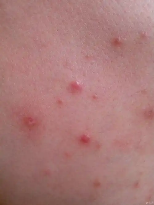 还有一例胸前丘疹的 - 皮肤及性传播疾病讨论版 - 爱爱医医学论坛