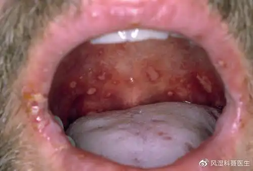 手足口病是怎样的疾病