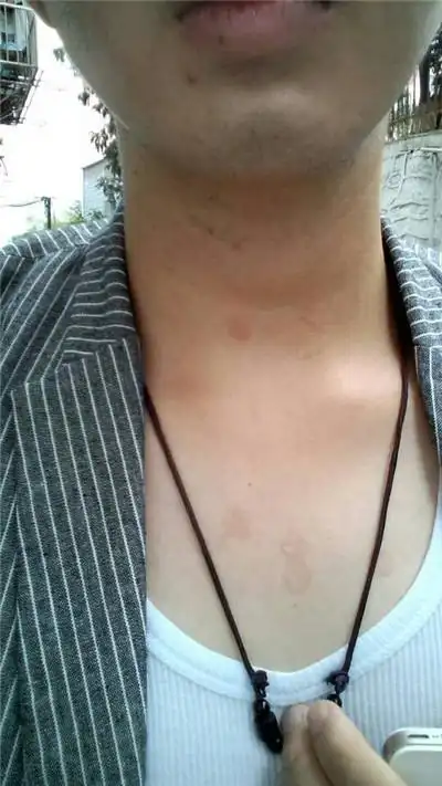 北京花斑癣医院_北京治疗花斑癣哪家医院好_北京治疗花斑癣权威的医院