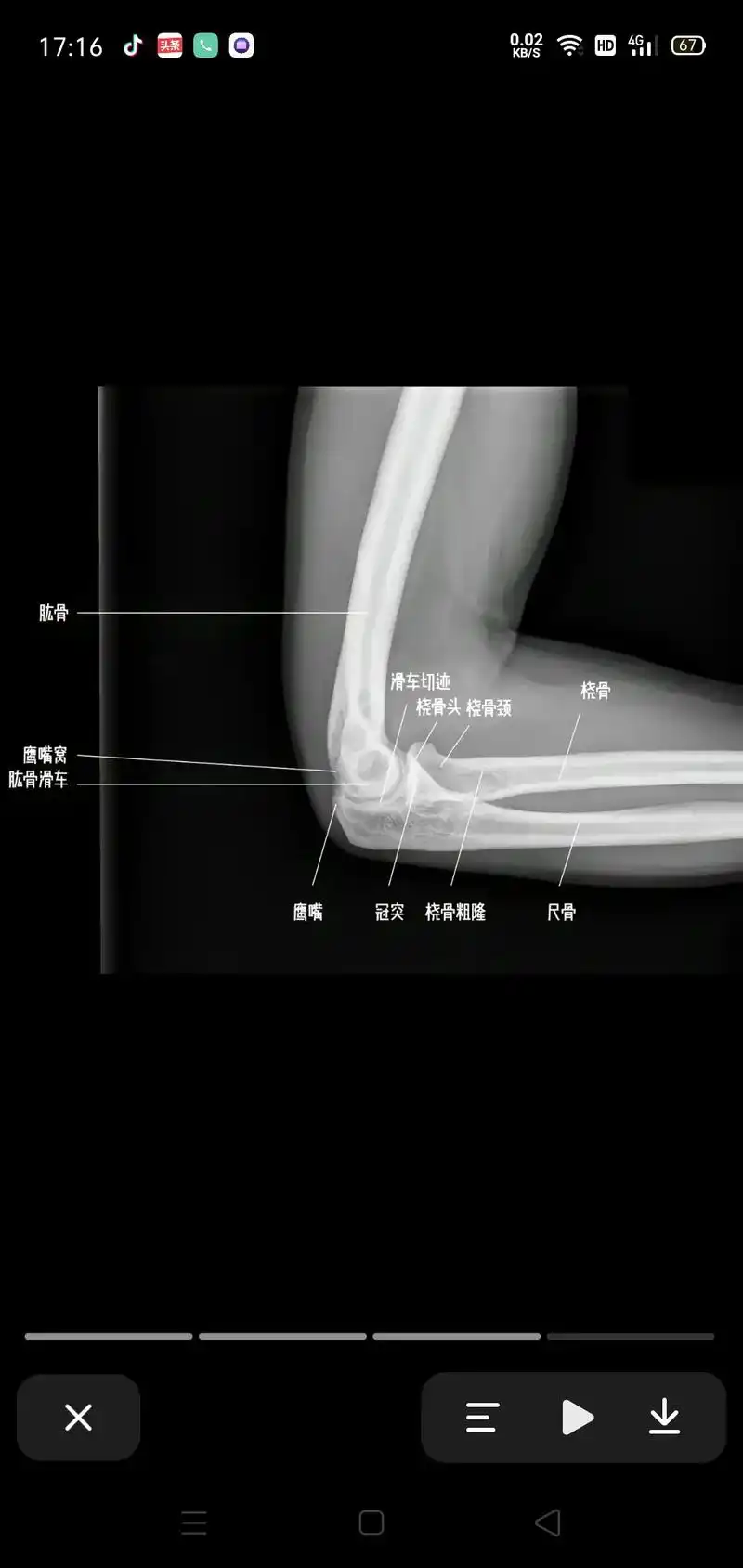 标准肘关节正侧位片图,人体结构 #医学影像 - 抖音
