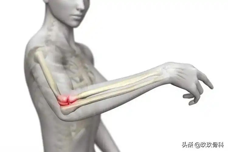 拧毛巾时手肘痛,咋回事儿?