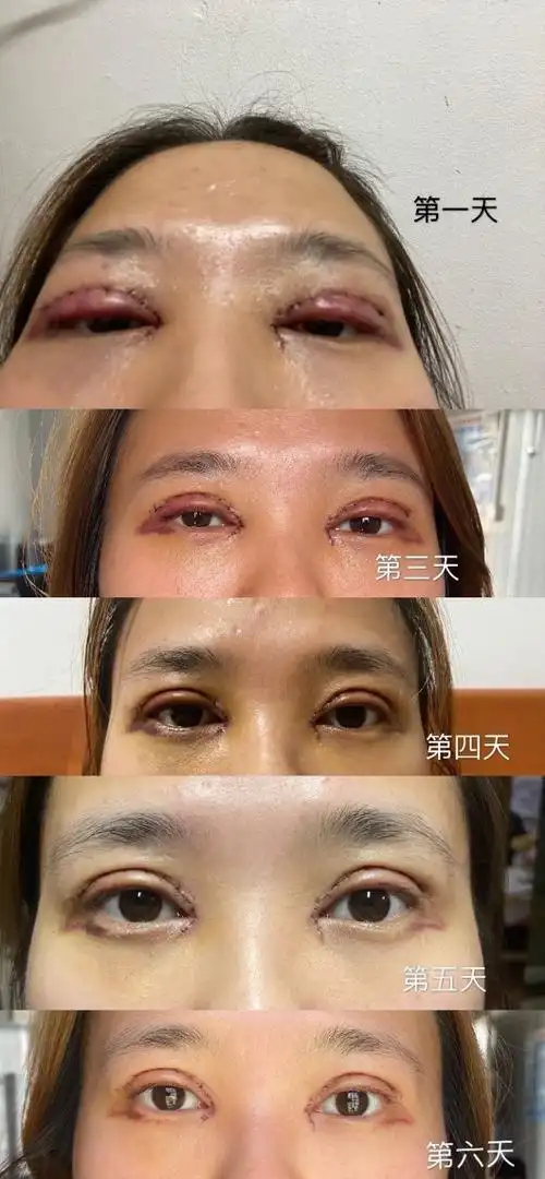 全切双眼皮手术开眼角