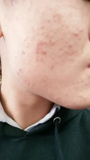 男生16岁,满脸痘痘,痘坑,痘印 ,怎么办