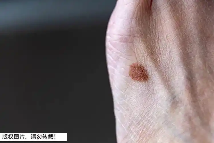 医生:死亡率非常高,尤其长在这种地方…_腾讯新闻