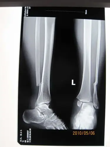 三踝骨折一例讨论分型及治疗