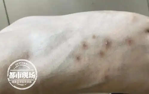 酒店住了3个月 女子起了一身包 她怀疑是床虱咬的_腾讯新闻