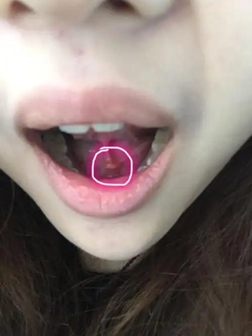 口腔溃疡长在舌头下面,不是舌背,一个星期了,发红有白尖,越长越大也不