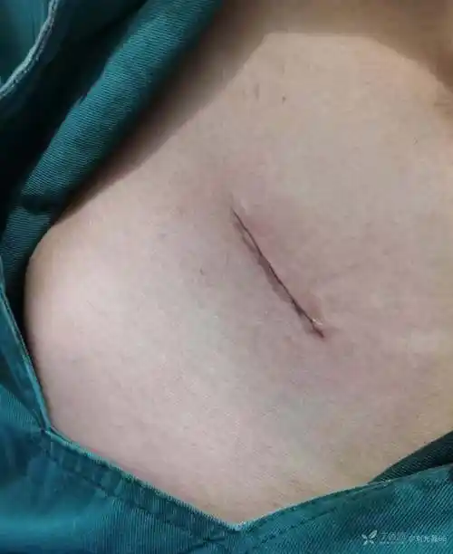 急性阑尾炎刀口用胶粘